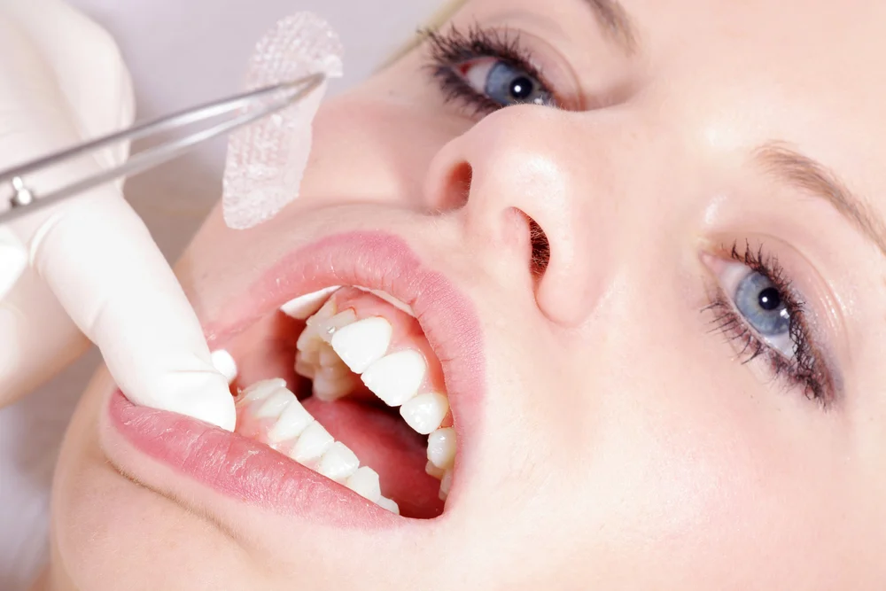 Lente de Contato Dental: O que é? Como funciona? 6 dentista dentes 1