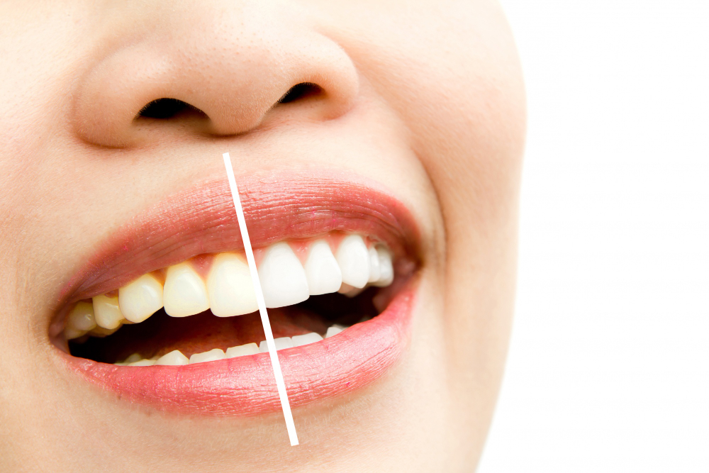 Bebidas que mancham os dentes: quais são e como evitar? 5 Cafe mancha os dentes
